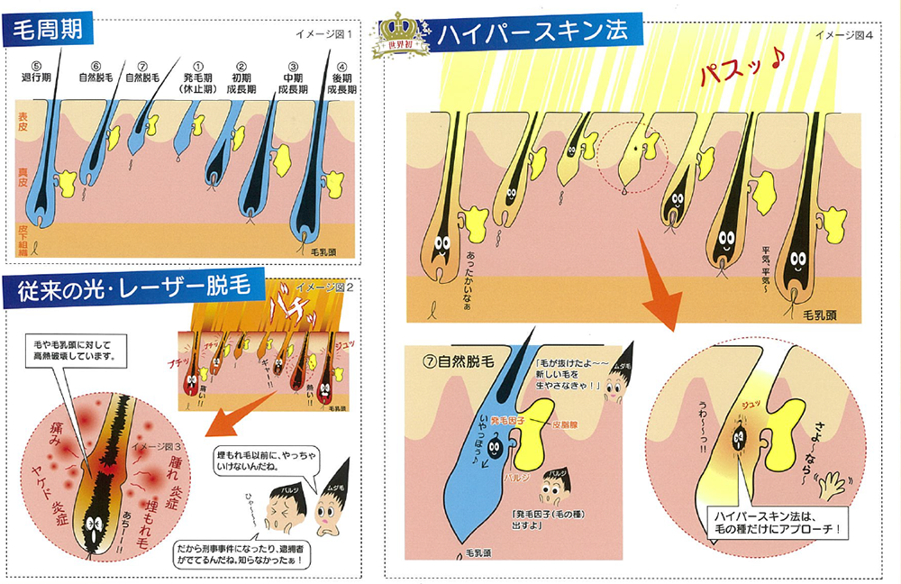 ハイパースキン法