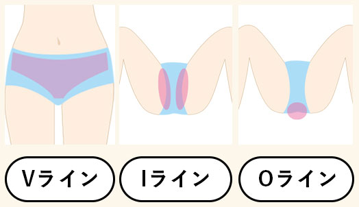 リンリンVIO脱毛